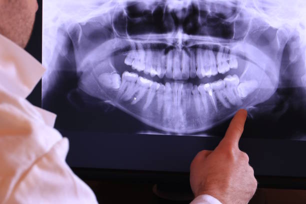 Best Emergency Wisdom Tooth Extraction in Spotswood, NJ